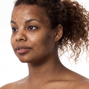 Hyperpigmentation & Teint Terne